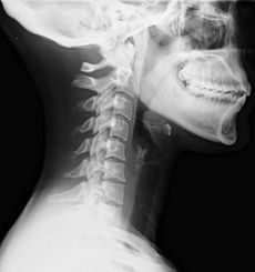 lateral neck x ray of whiplash