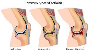 arthritis commontypes